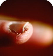 Fungal Nail Infections treatment